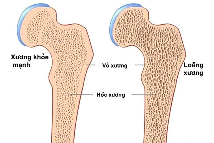 Collagen có thể ngăn ngừa mất xương