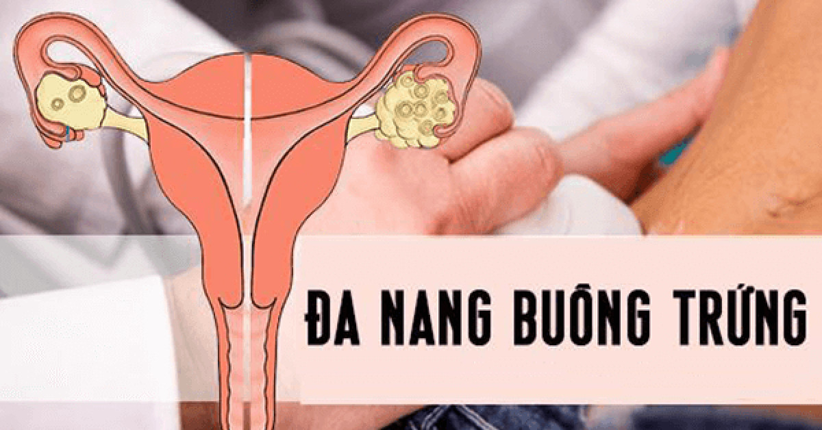Phòng ngừa đa năng buồng trứng