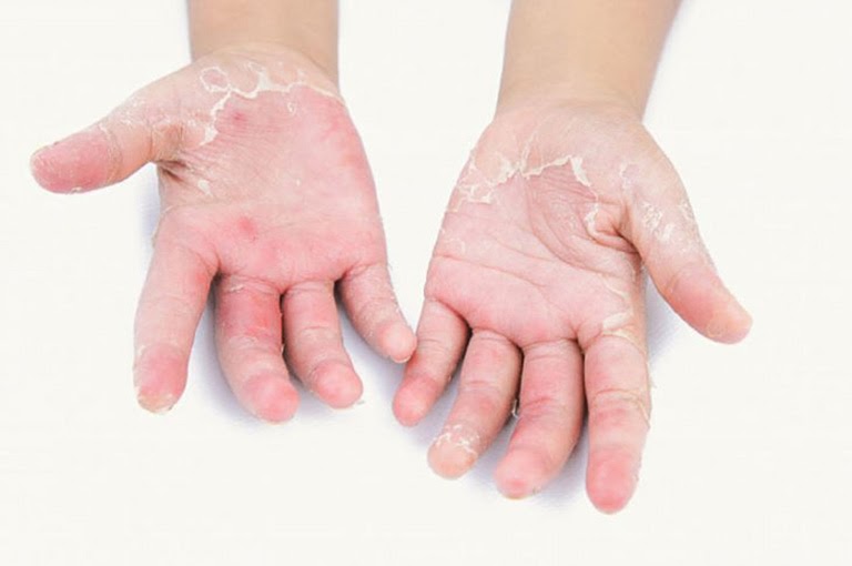 Điều trị các bệnh về da