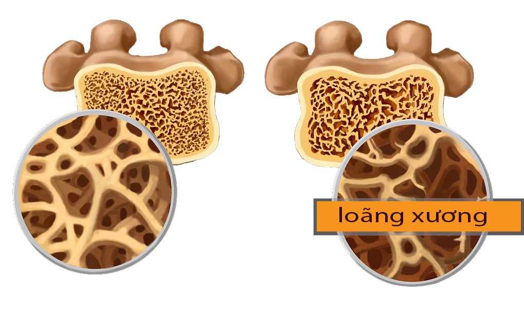 Hỗ trợ điều trị loãng xương