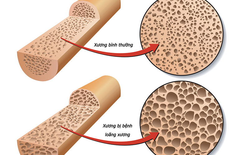 Canxi là một loại khoáng chất có vai trò rất quan trọng trong cơ thể người.